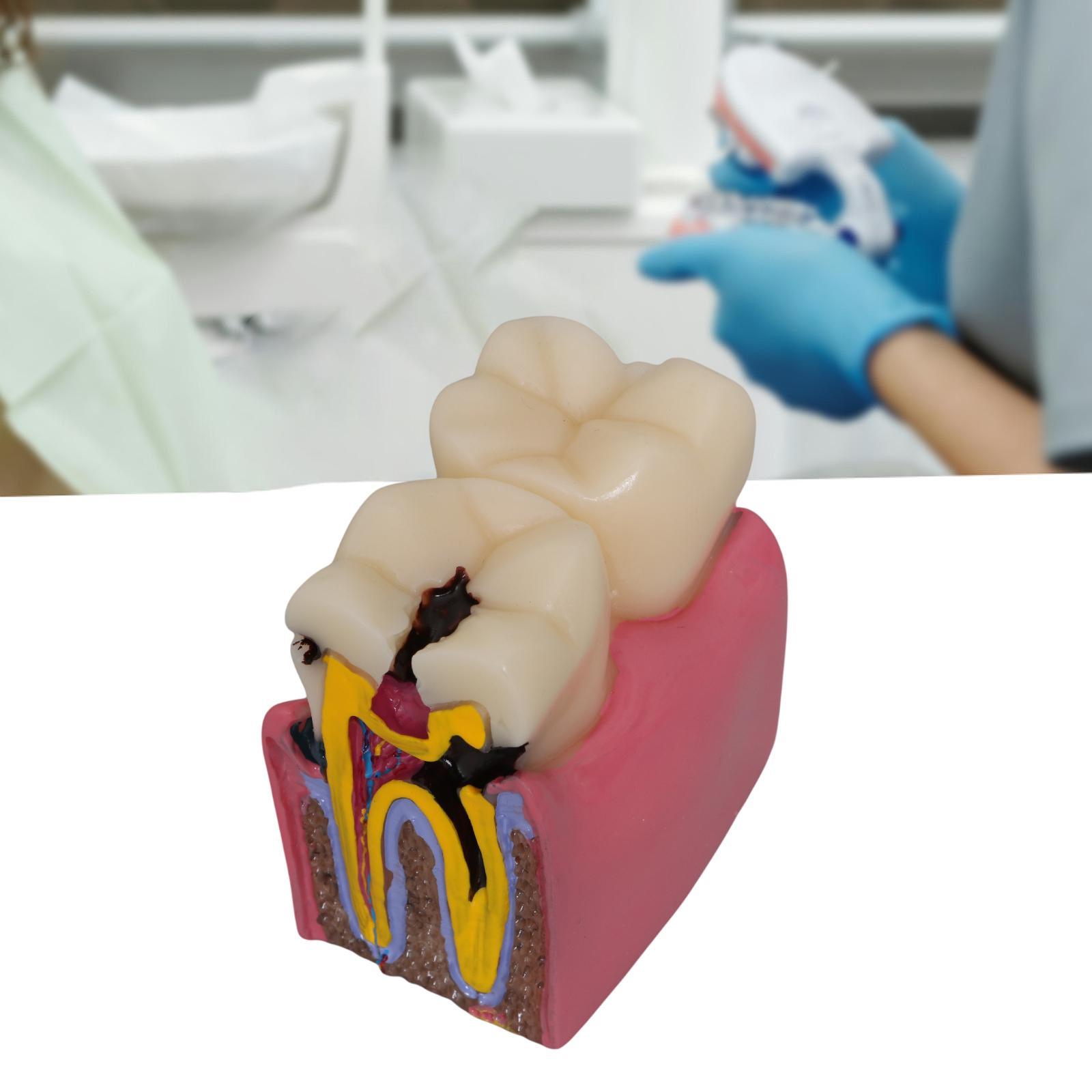 Tooth Decay Model Roots Canal  - Kids Education Classes บทวิจารณ์และราคา