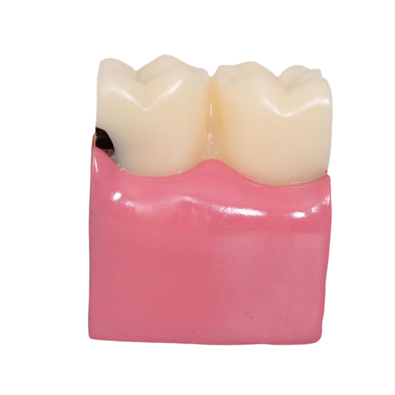 Tooth Decay Model Roots Canal  - Kids Education Classes บทวิจารณ์และราคา