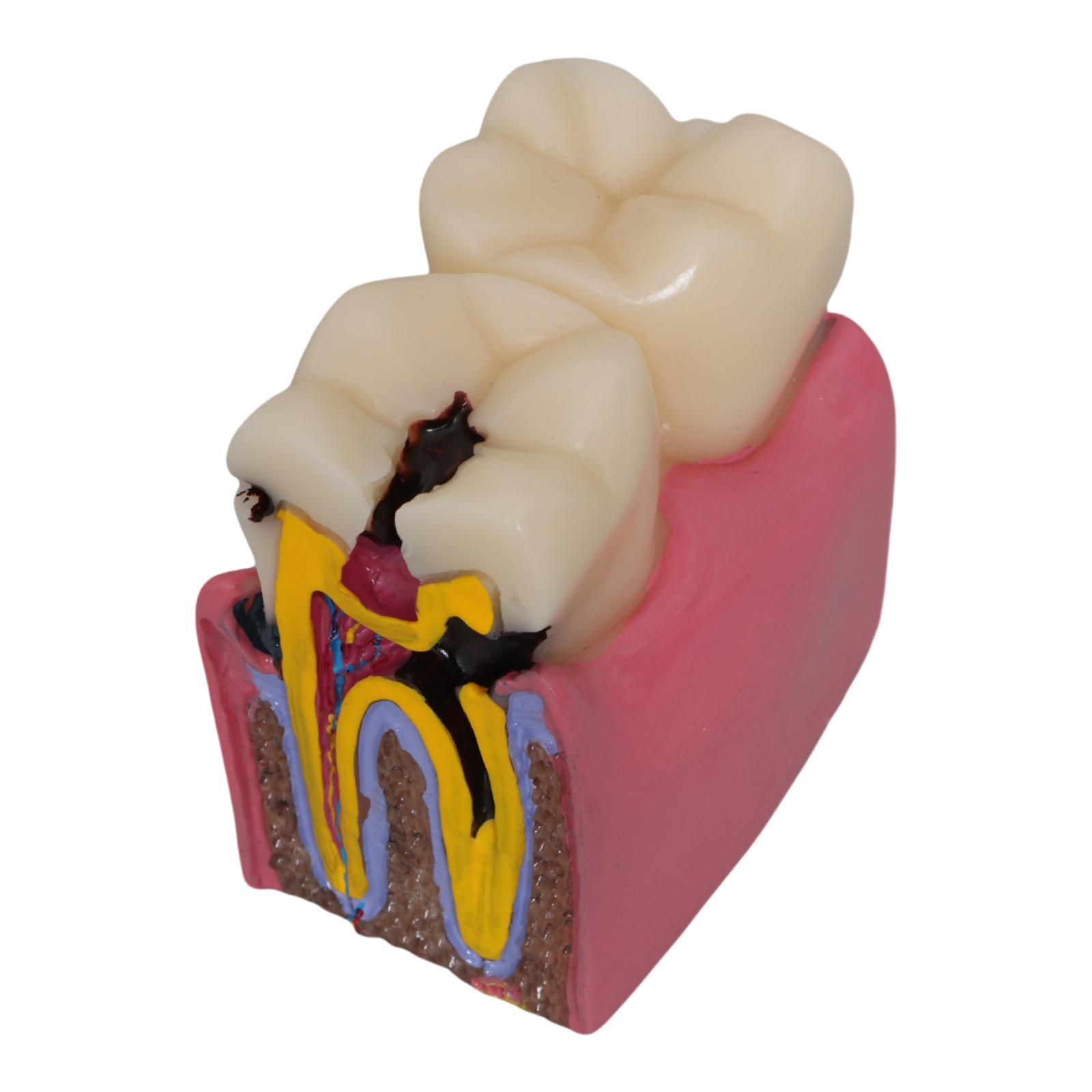 Tooth Decay Model Roots Canal  - Kids Education Classes บทวิจารณ์และราคา